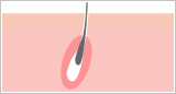 毛根のイメージ図