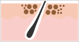 毛根と、皮膚の黒ずみのイメージ図