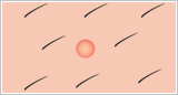 毛嚢炎のイメージ図